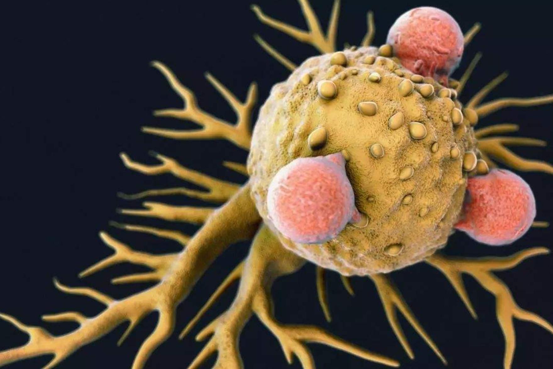 幽门螺杆菌与胃癌
